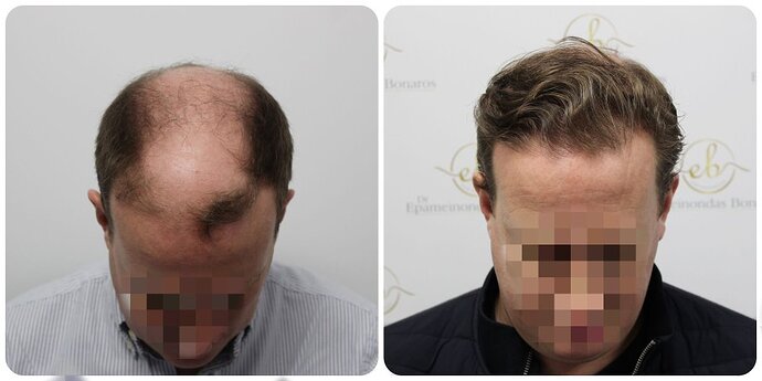 Dr Bonaros, Glasgow, UK / 4013 FUE grafts / 0-12 Months photo