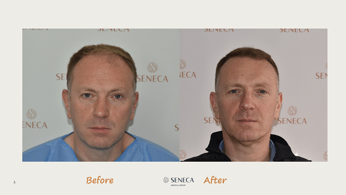 Seneca Medical Group - 3189 grafts with Direct Fue photo