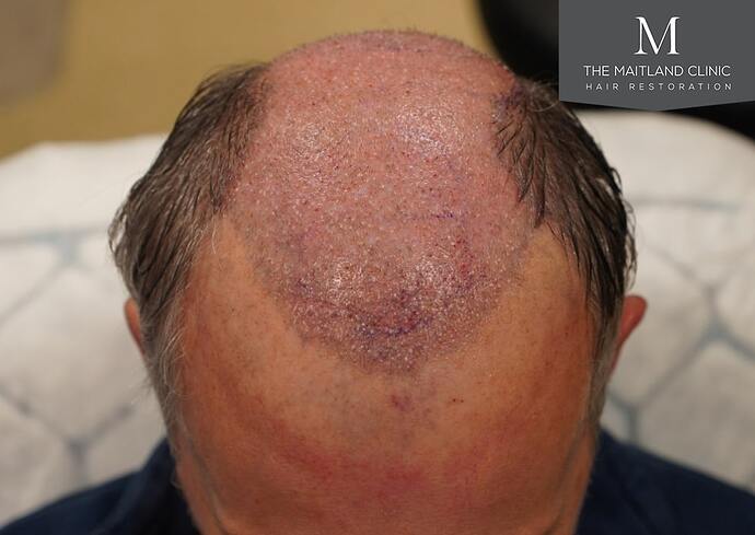 Dr Ball - The Maitland Clinic 2448 Grafts By FUT photo