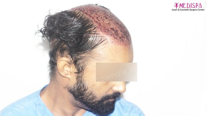 Revision Hair Transplant - 5111 Grafts / 5 Years Result - Dr. Suneet Soni, Medispa India photo