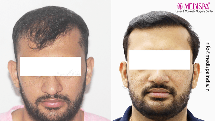 Dr. Suneet Soni - 4665 Grafts, Combine FUT + FUE + BHT (Beard) Technique photo