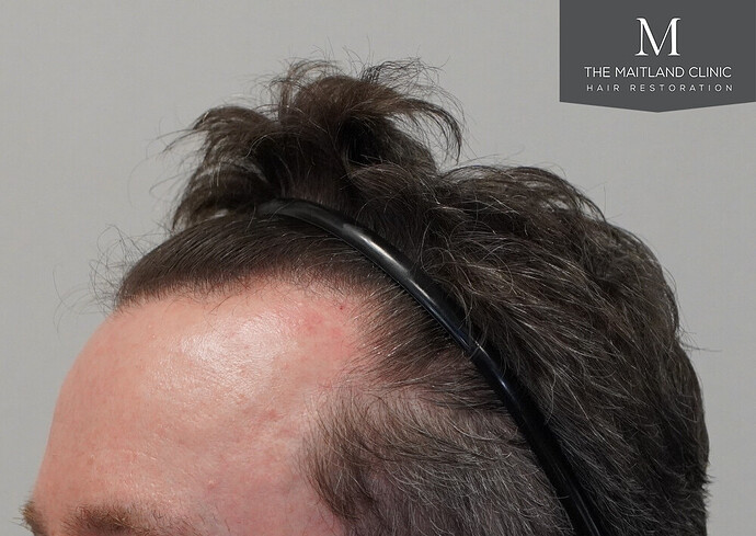 Before and after results: 1694 grafts by FUE at The Maitland Clinic (Dr Edward Maitland Ball) photo