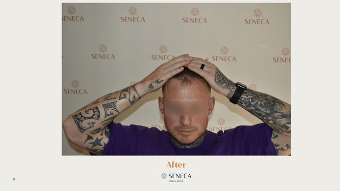 Seneca Medical Group - 1556 grafts with Direct FUE photo