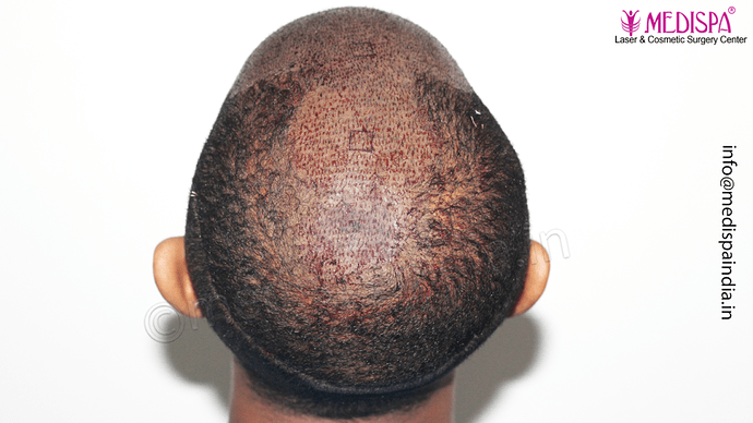 Dr. Suneet Soni - Afro Hair Transplant, 2 Sessions, 8355 Grafts, Combined FUT + FUE Technique, NW-VI, 5 Years Result photo