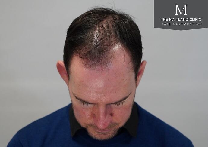 Dr Ball - The Maitland Clinic 1432 Grafts By FUE photo