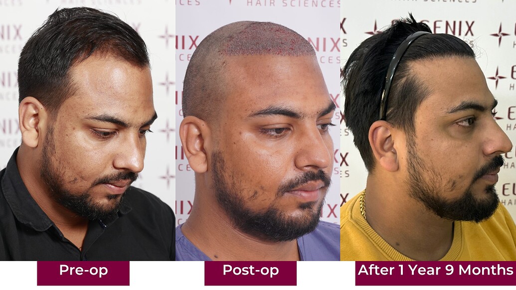 https://cdn.forumhairtransplant.com/optimized/3X/7/e/7e1fbf14d462e0e453082889e433351b3f3c9b73_2_1035x582.jpeg