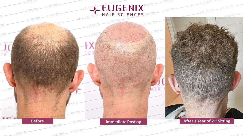 https://cdn.forumhairtransplant.com/optimized/3X/7/e/7e320f48cf5a0942da991d447494c18cbc6ffa29_2_1035x582.jpeg