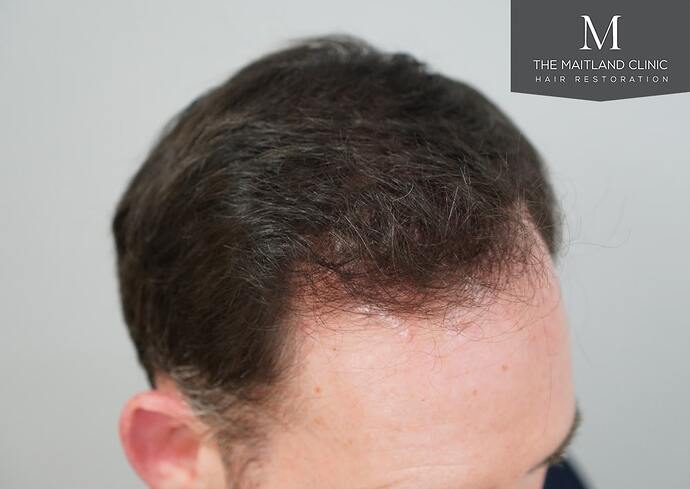 Dr Ball - The Maitland Clinic 1432 Grafts By FUE photo