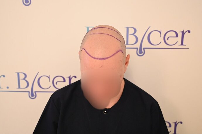Ozlem Bicer MD-Hair Transplant-3980 Grafts FUE by micro-motor, 12. months result photo