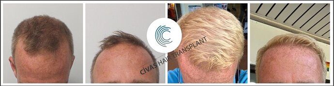 Civas Hair Transplant--3200 grafts--Fue--1 year photo