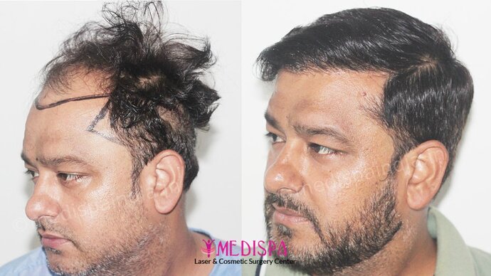 Dr. Suneet Soni - 5000 Grafts, Combine FUT + FUE + BHT (Beard) Technique, NW-V, 2.5 Year Result photo