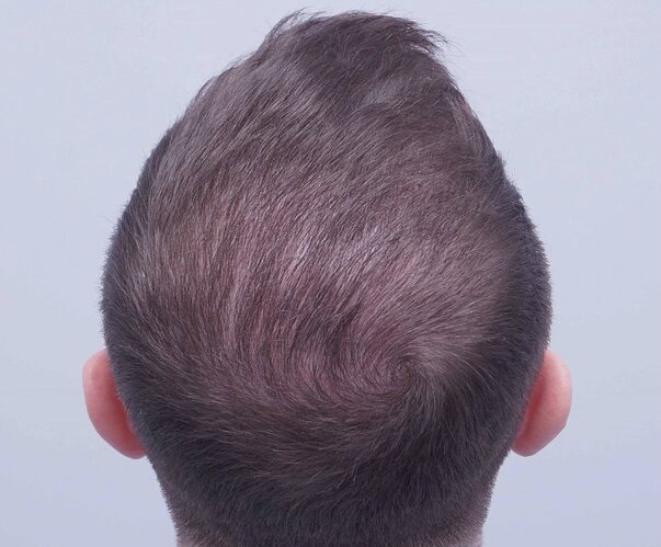 FUE Hair Transplant - 2,300 Grafts - Dr Bessam Farjo photo