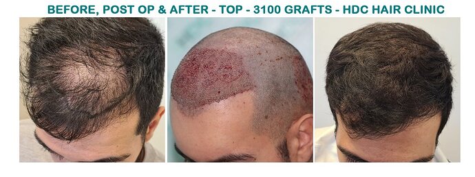 FUE Hair Transplant Result for 3100 Grafts - NW3 – 8 Months After – HDC Hair Clinic photo