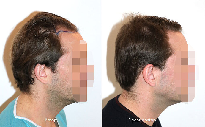 Case performed by Dr. Feriduni – 3322 FU in 1 procedure photo