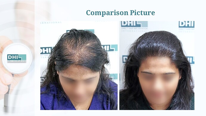 Female Hair Transplant | 1,359 Grafts | 6-Months Result | DHI India™ photo