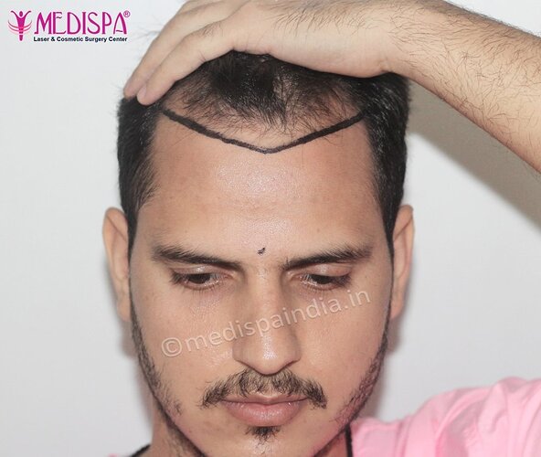 Dr. Suneet Soni - 2500 FUE Grafts, NW- III photo