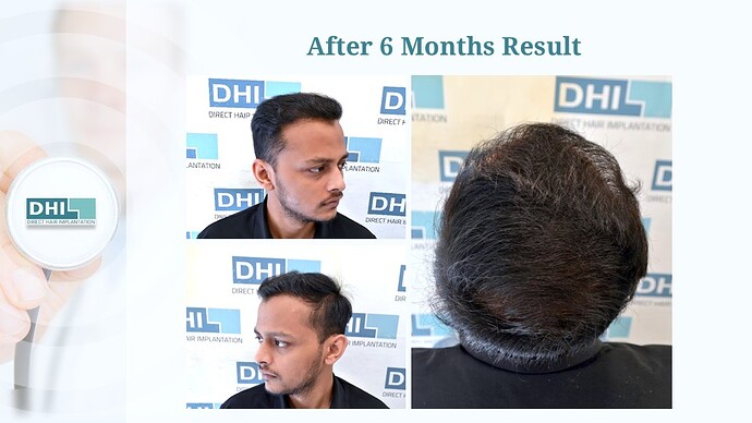 DHI India™ | NW 4 | 4,265 Grafts | 6-Months DHI™ Hair Transplant Results photo