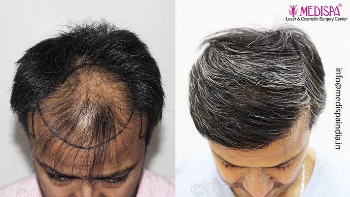 Dr. Suneet Soni - 4889 Grafts | 2.5 Years Result | Combination FUT + FUE + Beard photo