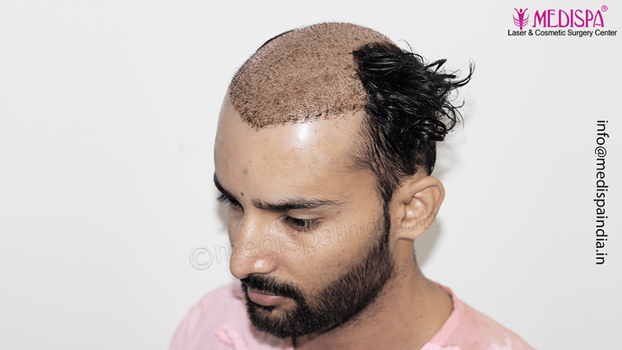 Dr. Suneet Soni - 4046 Grafts | 12-Month Result | Combination FUT + FUE + Beard photo