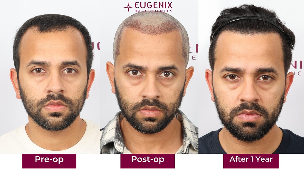 https://cdn.forumhairtransplant.com/optimized/3X/7/f/7ffd3a4dc472bc714768946393bd59b62ca343a9_2_1035x582.jpeg