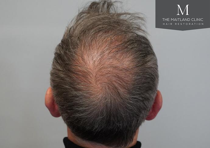 Dr Ball - The Maitland Clinic 2448 Grafts By FUT photo