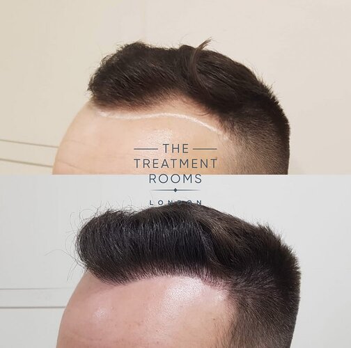 Before and after FUE Hair Transplantation 1292 Grafts photo