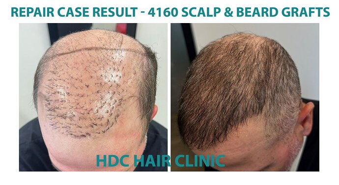 Major Repair of Mini Grafts - Result: 4160 Grafts – HDC Hair Clinic photo