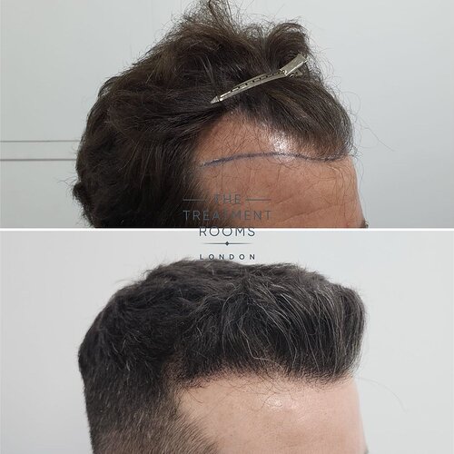 Hairline Transplant- 1745 Grafts- 14 Months Post Surgery photo