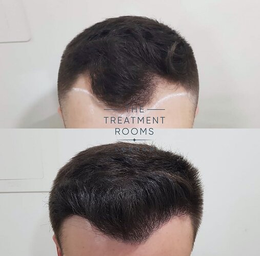 Before and after FUE Hair Transplantation 1292 Grafts photo