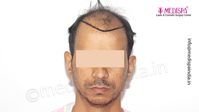 Dr. Suneet Soni - 4533 Grafts, Combine FUT + FUE Technique , NW-IV/V photo