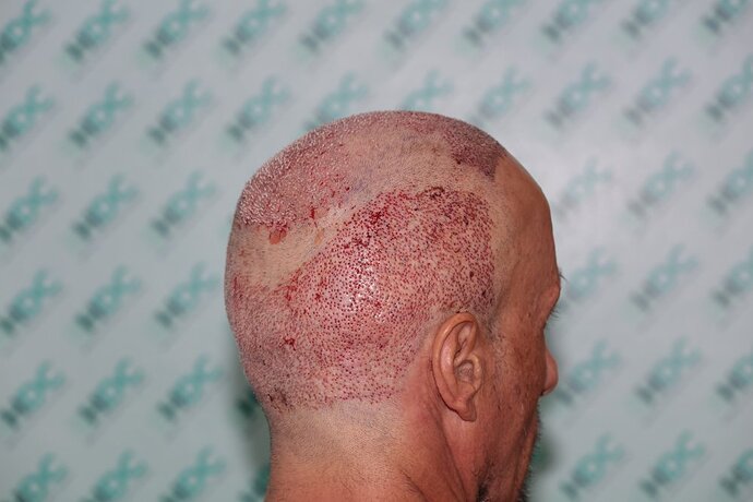 Hair Transplant Outcome with 4000 Grafts Across NW5 Zone – HDC Hair Clinic photo