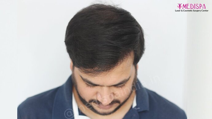Dr. Suneet Soni - 4937 Grafts, Combine FUT + FUE Technique, NW : IV-V photo