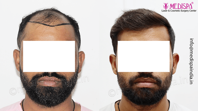 Dr. Suneet Soni - 5360 Grafts | 12-Month Result | Combination FUT + FUE + Beard photo