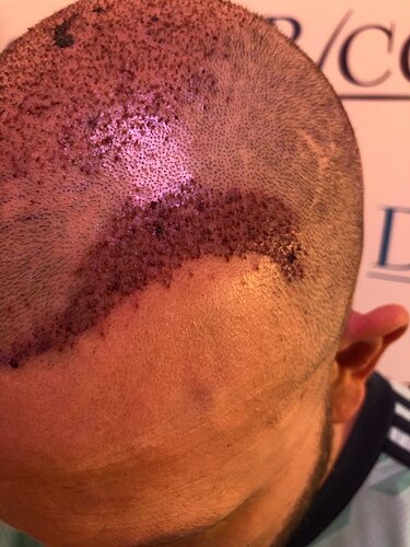 Ozlem Bicer MD-Hair Transplant-3560 Grafts FUE by micro-motor, 9. months result photo