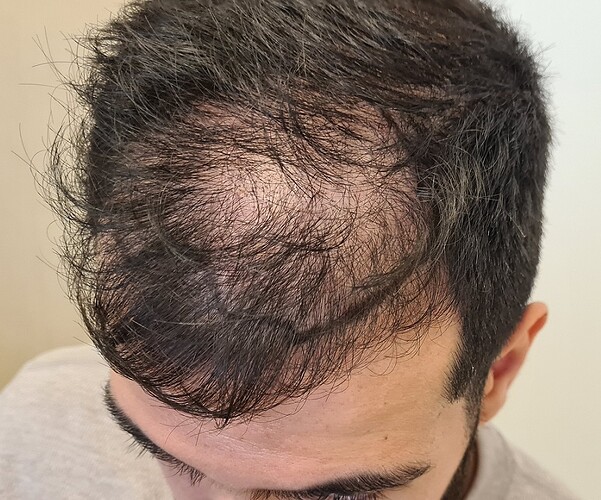 FUE Hair Transplant Result for 3100 Grafts - NW3 – 8 Months After – HDC Hair Clinic photo