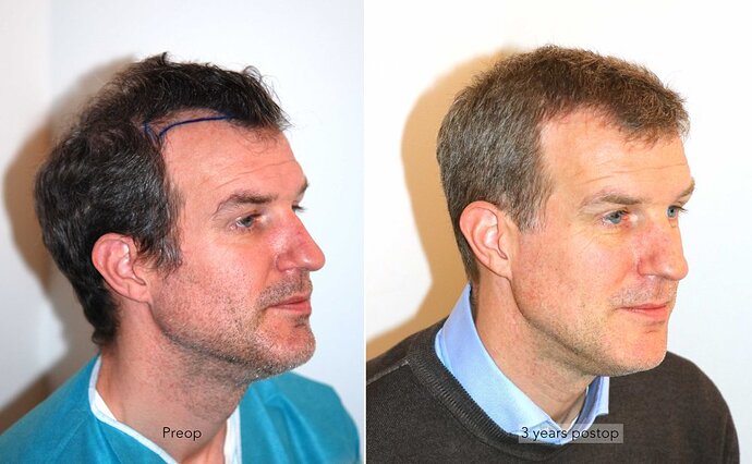 Case performed by Dr. Feriduni – 3883 FU in 1 procedure photo