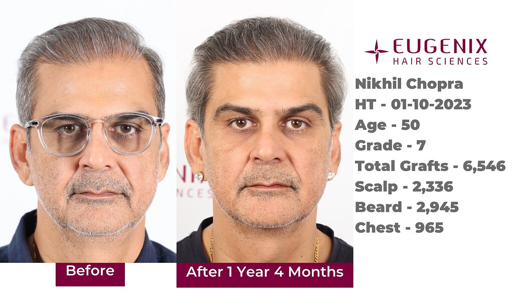 https://cdn.forumhairtransplant.com/optimized/3X/8/1/81a8179ed204f37f156e2604e50064d763f1b8ef_2_1035x582.jpeg