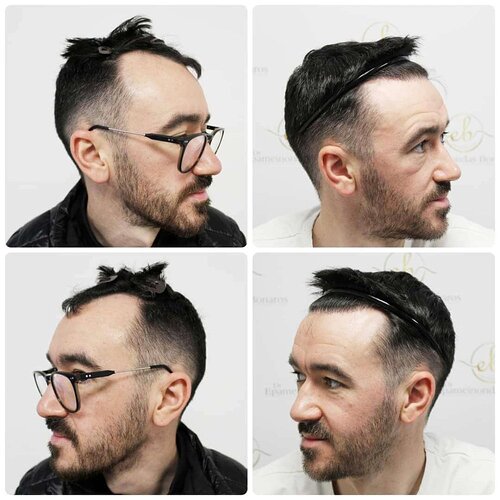 Dr Bonaros, Glasgow, UK / 1816 FUE grafts / 0-12 Months photo