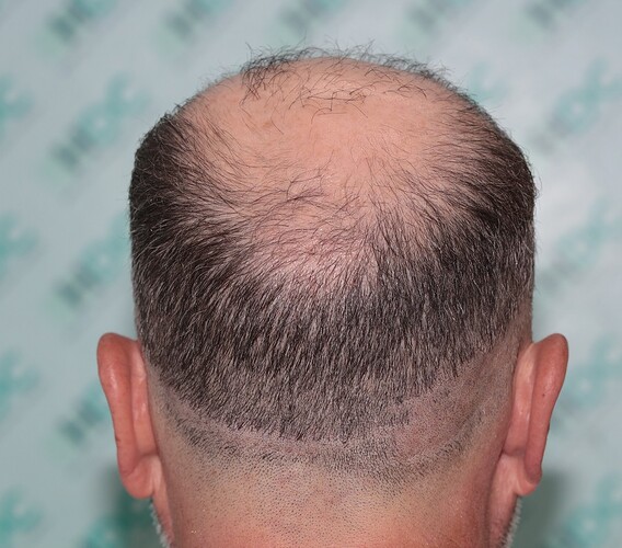 Major Repair of Mini Grafts - Result: 4160 Grafts – HDC Hair Clinic photo