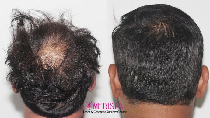 Dr. Suneet Soni - 5000 Grafts, Combine FUT + FUE + BHT (Beard) Technique, NW-V, 2.5 Year Result photo