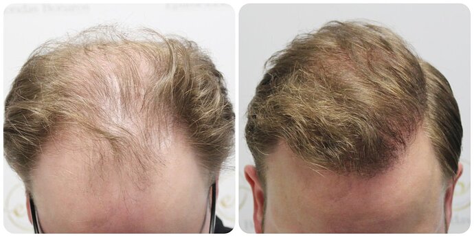 Dr Bonaros, Glasgow, UK / 4081 FUE grafts / 0-12 Months photo