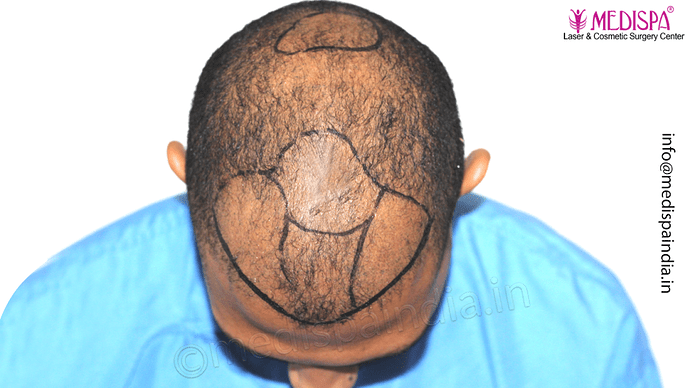 Dr. Suneet Soni - Afro Hair Transplant, 2 Sessions, 8355 Grafts, Combined FUT + FUE Technique, NW-VI, 5 Years Result photo