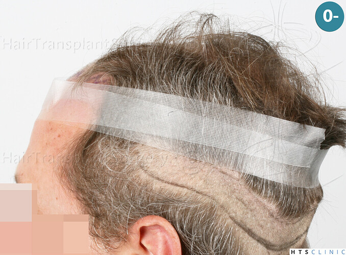 Dr Devroye + Dr Montesanti + Dr Jenard / 7015 grafts (4512 FUT + 2503 FUE) / 2 sessions photo