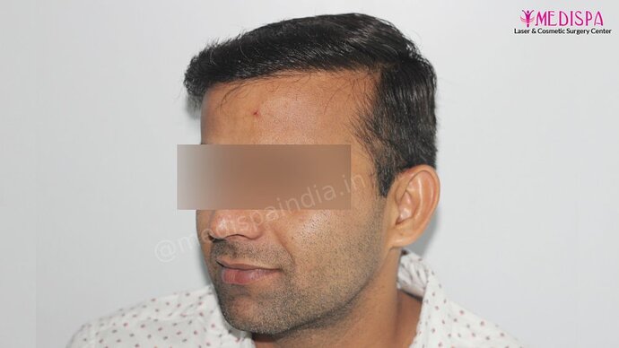 Dr. Suneet Soni - 4025 Grafts | 12-Month Result | Combination FUT + FUE photo