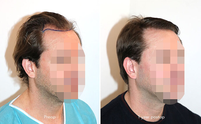 Case performed by Dr. Feriduni – 3322 FU in 1 procedure photo