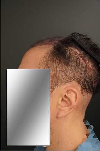 Hattingen Hair Clinic, 4 435: 4 093 FUT and 342 FUE. photo