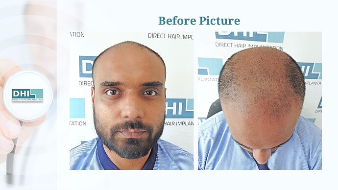 DHI India™ | NW 6 | 4,473 Grafts | 1-Year Hair Transplant Result photo