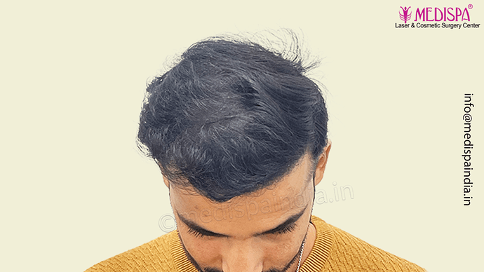 Dr. Suneet Soni - 4046 Grafts | 12-Month Result | Combination FUT + FUE + Beard photo