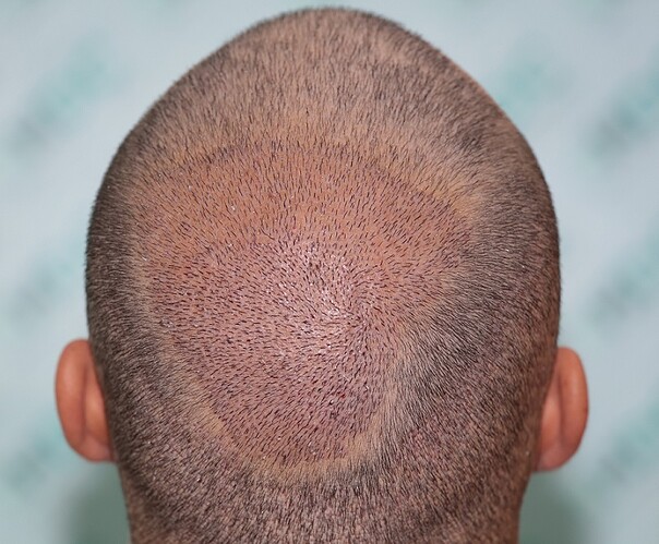 Result of 6800 FUE grafts in two sessions – 7 months after 2nd Session – Dr Maras – HDC Hair Clinic photo