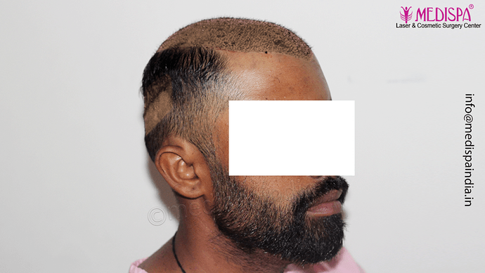 Dr. Suneet Soni - 5360 Grafts | 12-Month Result | Combination FUT + FUE + Beard photo